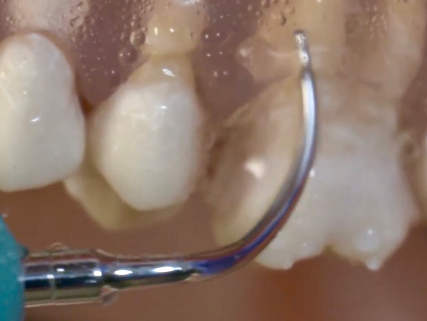 Beyond the Numbers: Rethinking CAL and the Biology of Periodontal Instrumentation